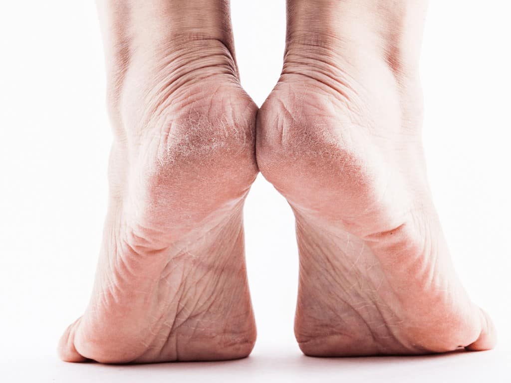 Nứt gót chân: Nguyên nhân và cách chữa