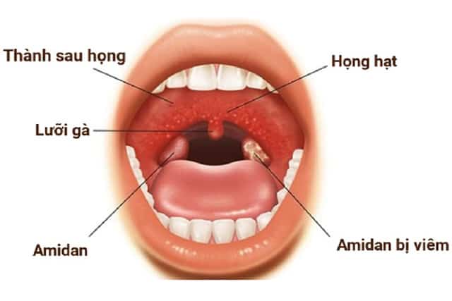 Viêm họng hạt: Cách chữa nhanh và đơn giản